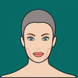 Buccal Fat Removal Surgery